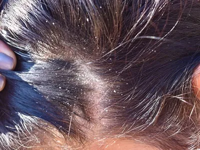 how seasonal changes trigger dandruff  