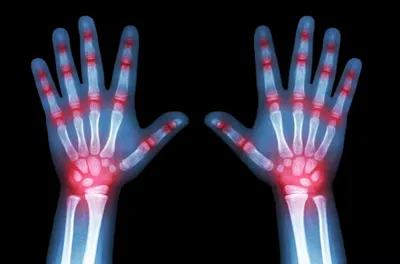 children get arthritis too  with life changing effects