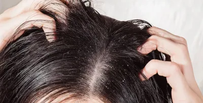 8 simple home remedies for instantly soothing an itchy scalp