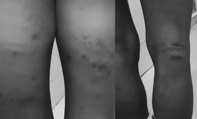 meghalaya  19 year old alleges custodial torture at sohra police station