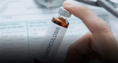 mizoram grapples with tuberculosis  595 cases detected this year