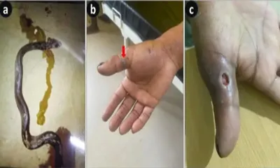 assam  doctor harps on global laurels for dead snakebite research