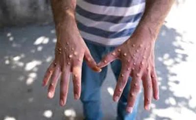 mizoram forms committee to tackle global monkeypox threat