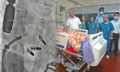 meghalaya  neigrihms performs eastern india s first transcatheter tricuspid valve repair