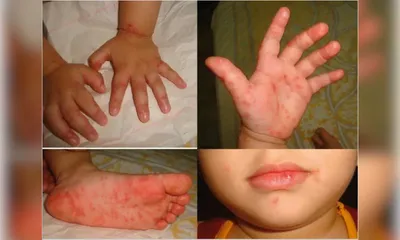 assam sees surge in hfmd infections  experts warn of contagious virus