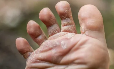 your summer shoes could be causing fungal infections  here’s how to prevent them