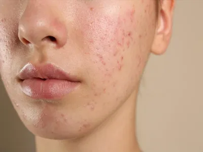 5 types of acne and its solutions