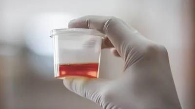 neglecting hematuria may be detrimental